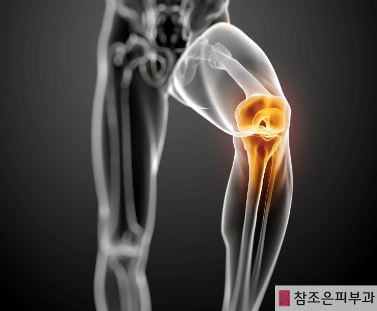 감기 몸살과 증상이 비슷한 대상포진 진단법 - 영등포 당산피부과 참조은피부과 관련 이미지 4