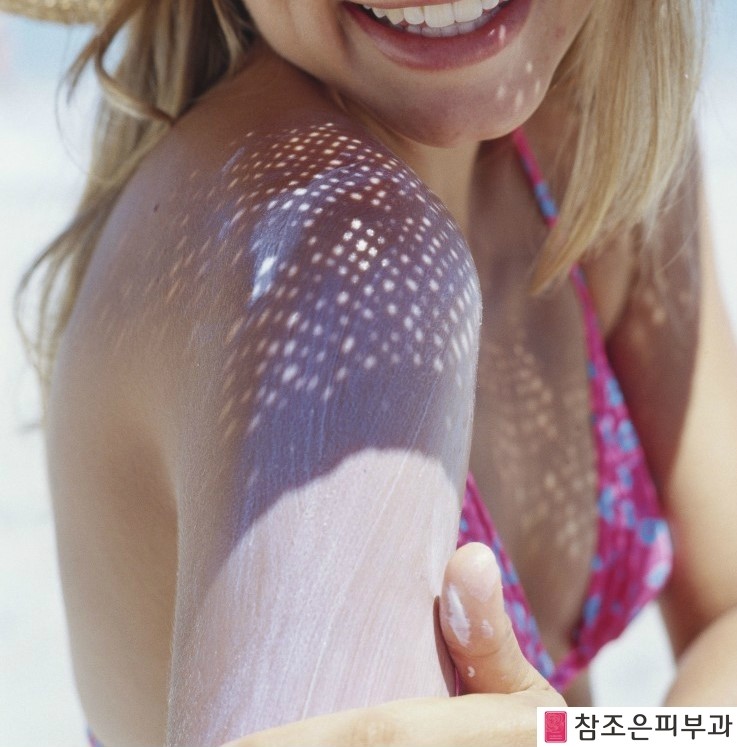 [공유] 휴가뒤 후유증 일광화상, 일사병 땀띠 치료- 당산역 참조은피부과 관련 이미지 4