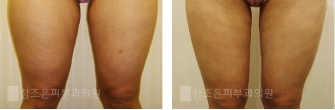 영등포 당산역/양평동 지방분해주사 참조은피부과 그 효과는? 관련 이미지 5
