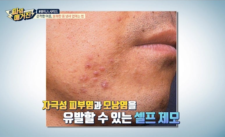 MBC 파워매거진 <여름 땀냄새>편, 임이석테마피부과 임이석 원장 인터뷰 관련 이미지 6
