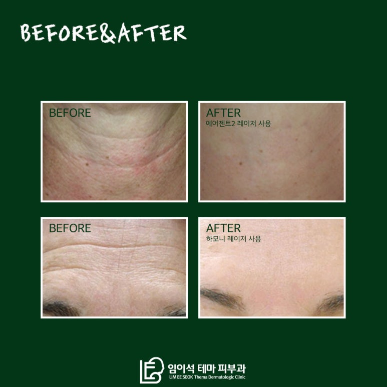 임이석테마피부과에서 알려드리는 나이 들면서 생기는 감출 수 없는 목주름, 원인과 개선 방법 관련 이미지 6