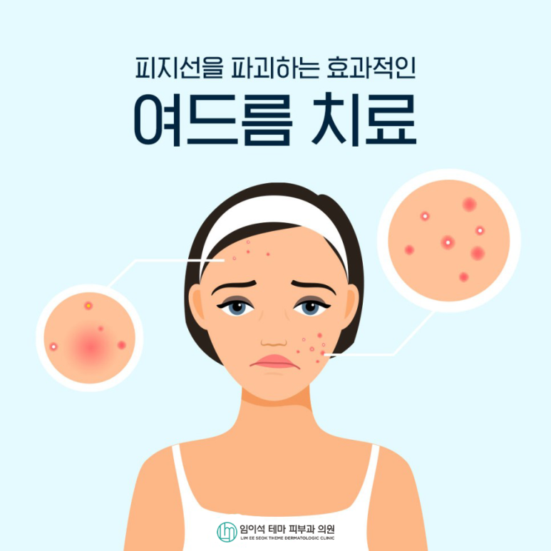 임이석테마피부과의원 피지선을 개선하는 효과적인 여드름 치료 관련 이미지 2