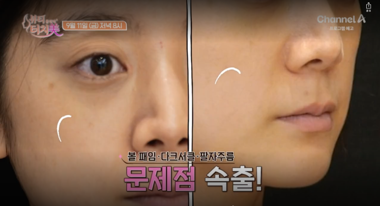 임이석 원장이 알려주는 피부 이야기 - 8화 우혜림편|채널 A 뷰티클리닉 터치미 9월 11일 방송 관련 이미지 5