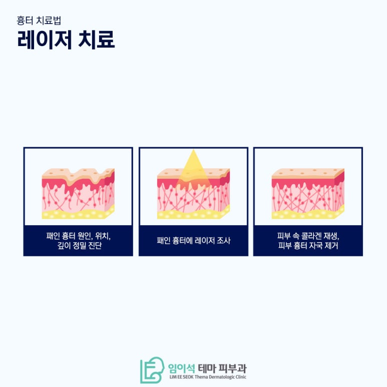 레이저를 활용한 다양한 흉터 제거 방법 관련 이미지 7