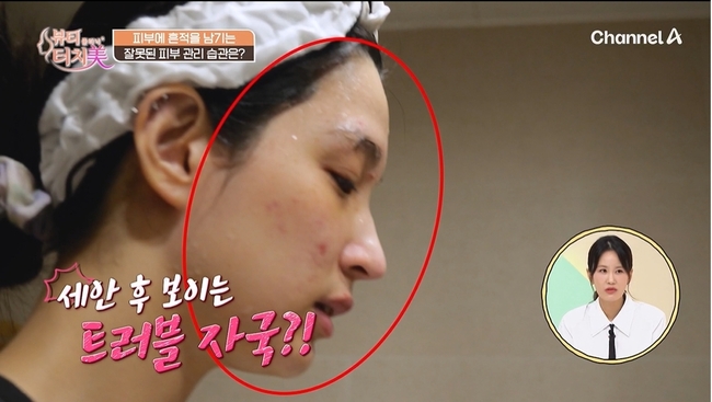 채널A 뷰티클리닉 터치미 5회~8회 사례로 알아보는 피부를 망치는 습관 모음집 [신사역 임이석테마피부과] 관련 이미지 3