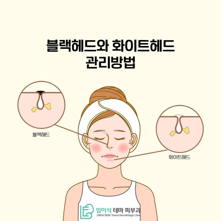 임이석테마피부과에서 알려드리는 블랙헤드와 화이트헤드 관리법 관련 이미지 2