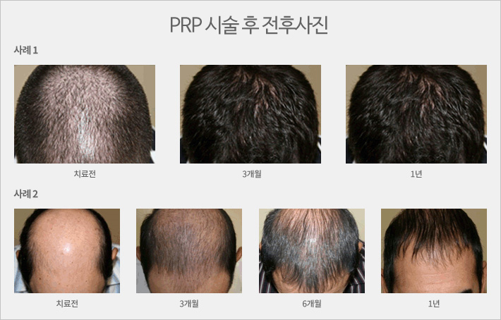 머리숱 풍성하게 관련 이미지 6