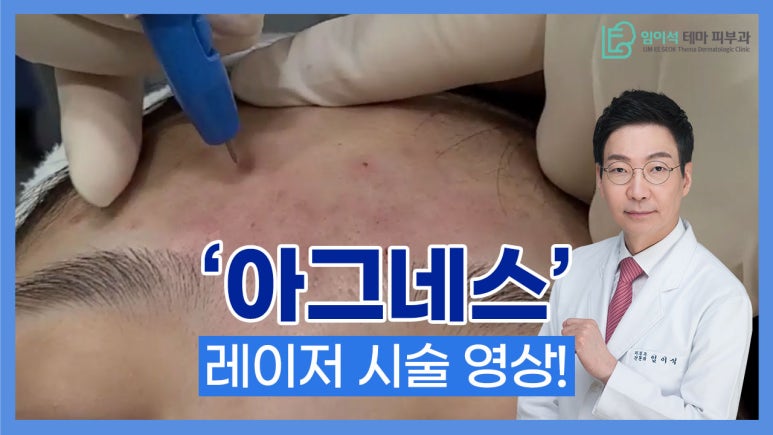 [Imi-seok Thema Dermatology YouTube Dr. Imi-seok Channel] Laser Treatment for Recurrent Acne image 2