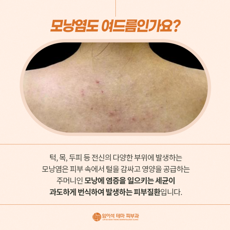 여드름의 종류, 원인, 치료, 흉터 관리법 관련 이미지 5