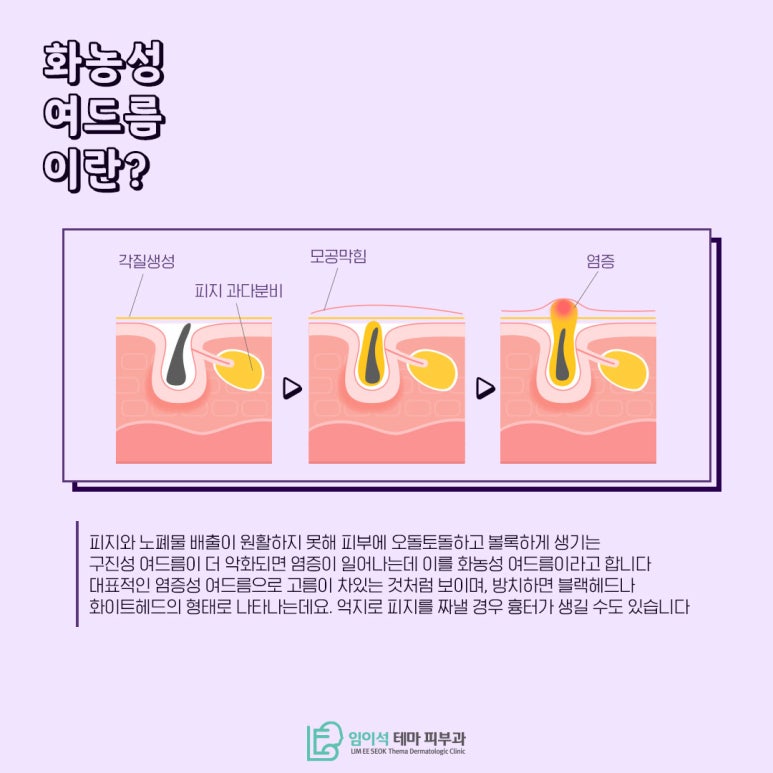 Pustular Acne Treatment, as Introduced by Imi-seok Theme Dermatology Clinic. image 3