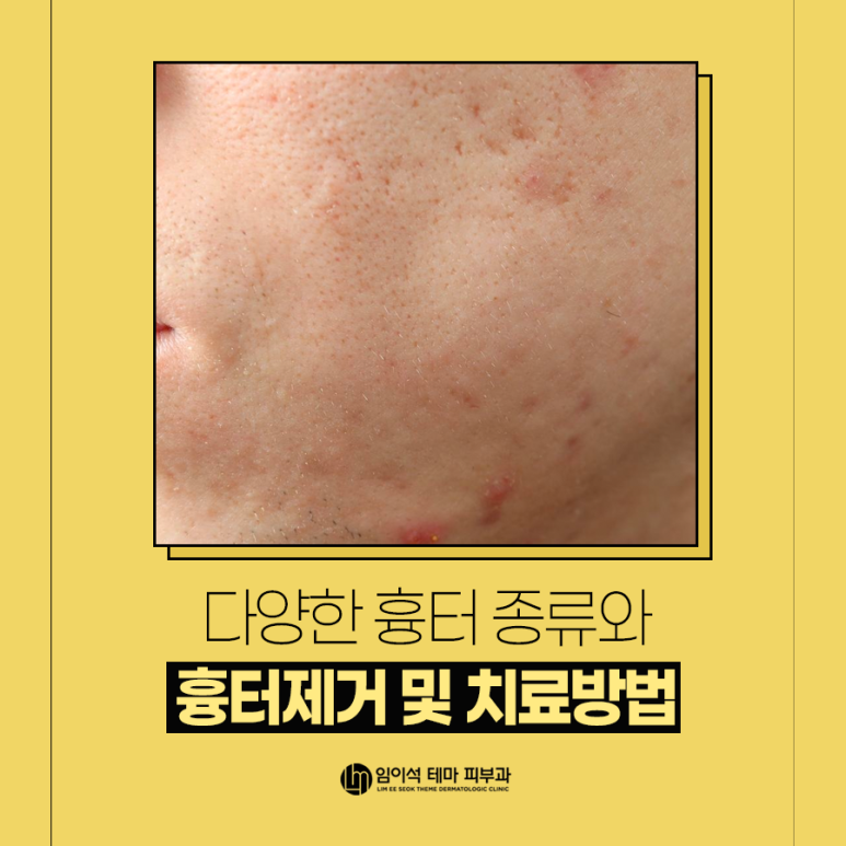 여드름흉터, 수술 흉터, 다양한 흉터 종류와 흉터제거 및 치료방법 관련 이미지 2