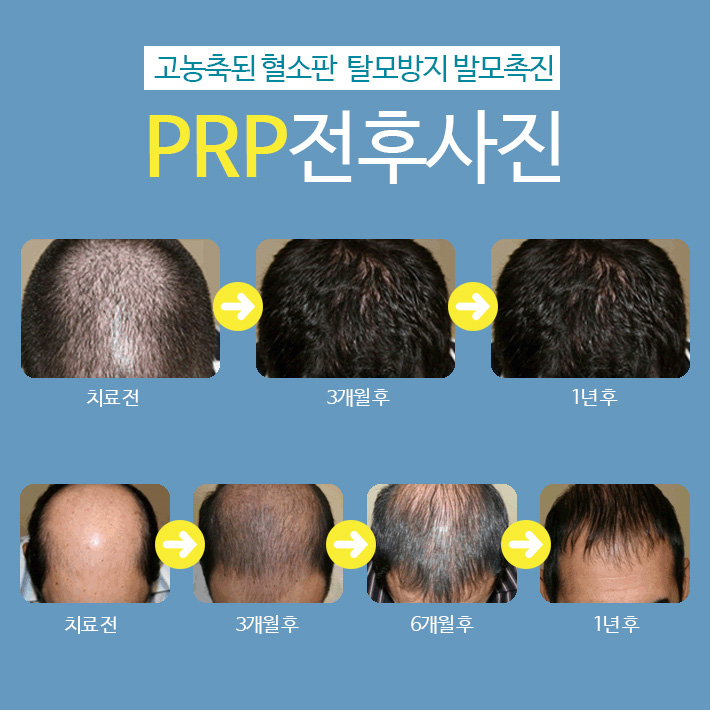 Imiseok Theme Dermatology Hair Loss Treatment Program image 8