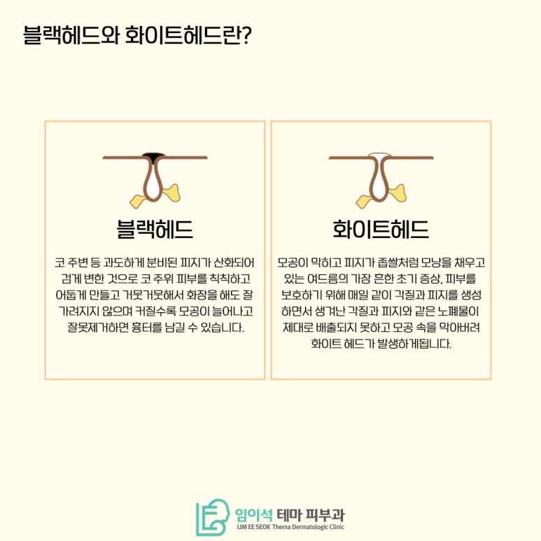 임이석테마피부과에서 알려드리는 블랙헤드와 화이트헤드 관리법 관련 이미지 3