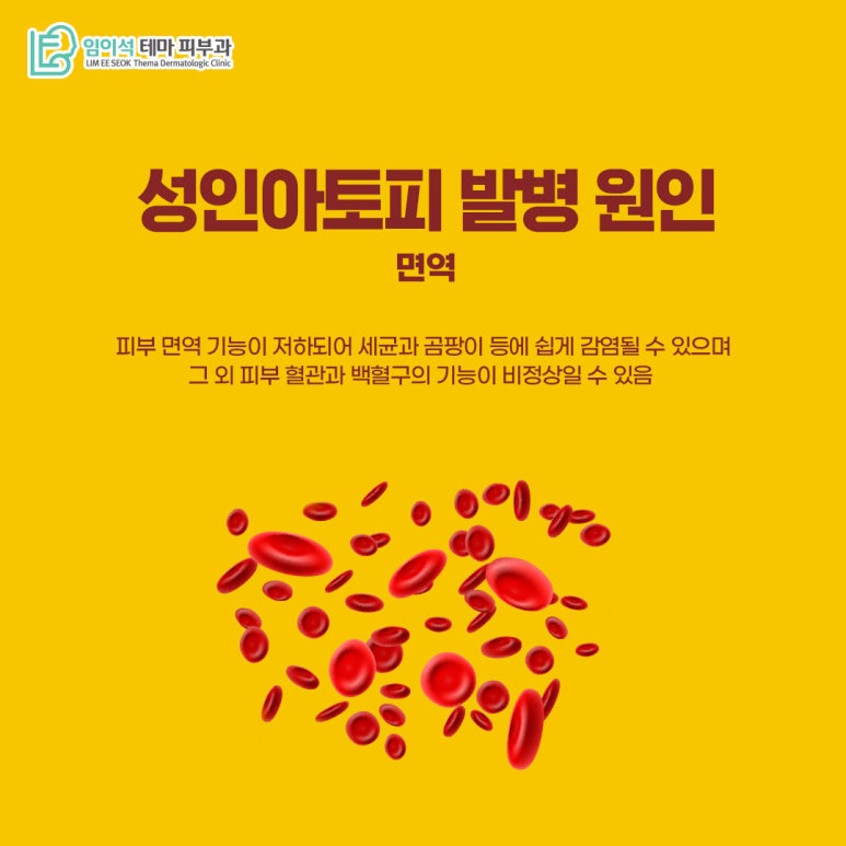 임이석피부과 성인아토피 피부염의 발병 원인과 치료법 관련 이미지 6