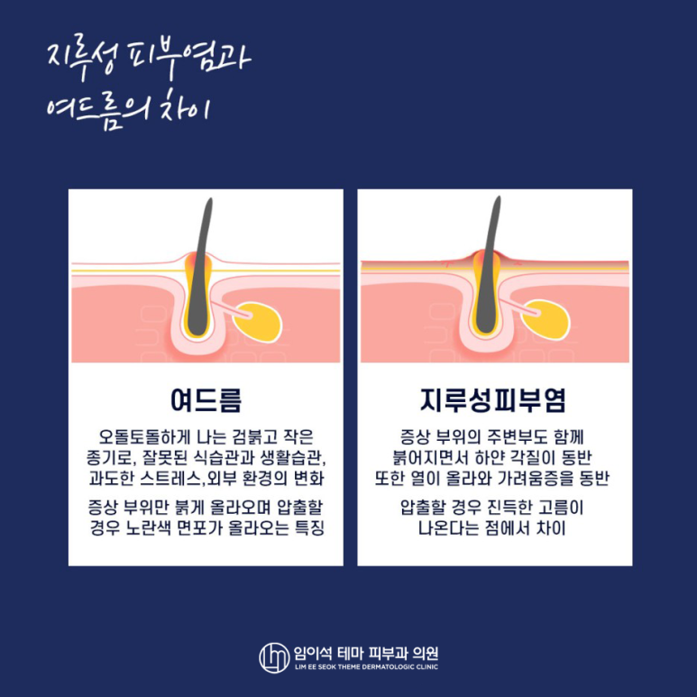 Seborrheic Dermatitis: Why It Should Be Treated Early and How to Treat It image 4