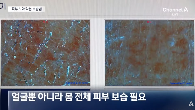 채널A 뉴스 - 임이석 대표원장 인터뷰 [피부 노화 막는 보습법]에 대해서 관련 이미지 5