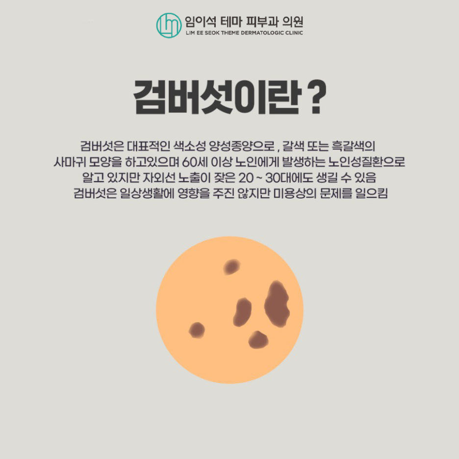 레이저를 이용한 검버섯 치료방법과 예방법 관련 이미지 3