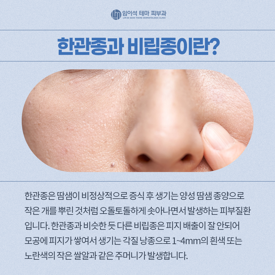 Differences Between Syringoma and Milia and How to Treat Them image 3