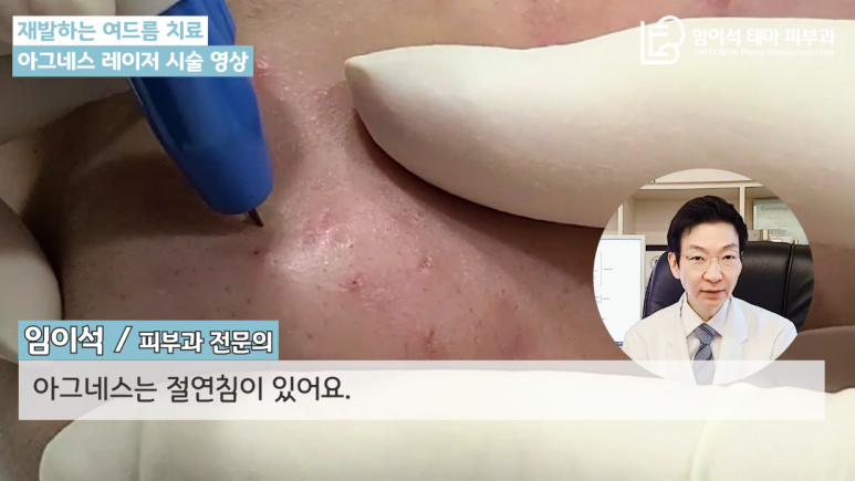 [Imi-seok Thema Dermatology YouTube Dr. Imi-seok Channel] Laser Treatment for Recurrent Acne image 4