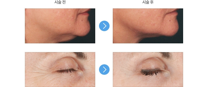얼굴주름리프팅 울쎄라 임이석테마피부과 관련 이미지 2