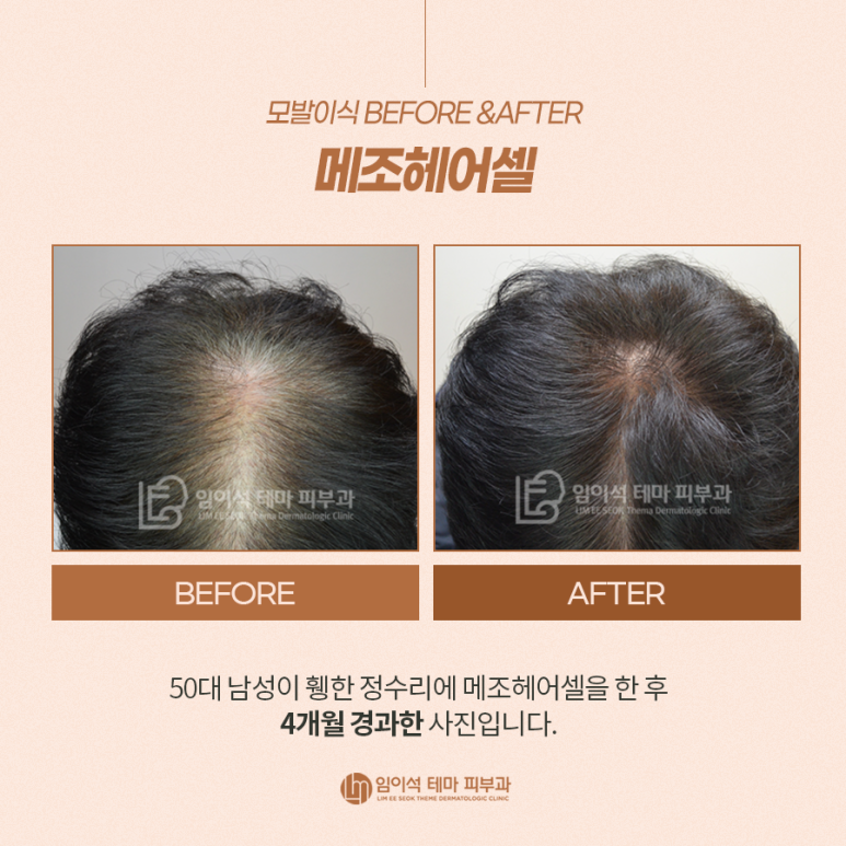 모발이식 Before&After와 이식 시 주의사항 관련 이미지 6