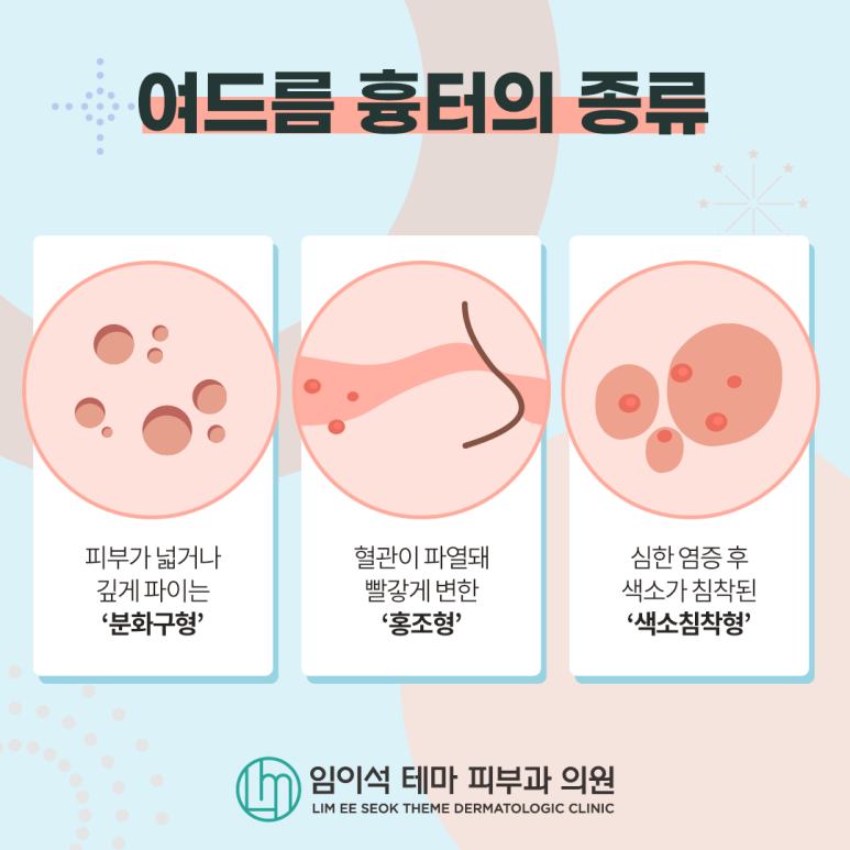 Causes of Acne and Treatment Methods for Adult Acne Scars image 4