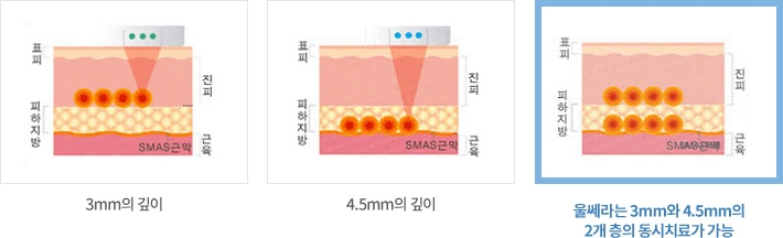 얼굴주름리프팅 울쎄라 임이석테마피부과 관련 이미지 4