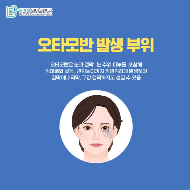 임이석피부과 오타모반, 난치성 색소질환의 발생 원인과 치료법 관련 이미지 4