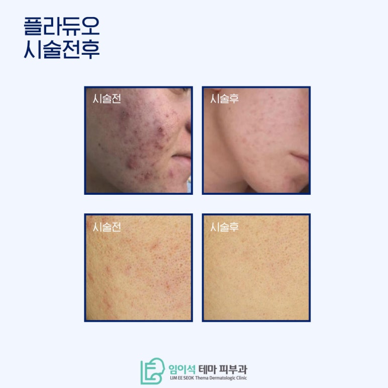 Limestone Theme Dermatology Laser Device ‘PlaDuo’ image 6