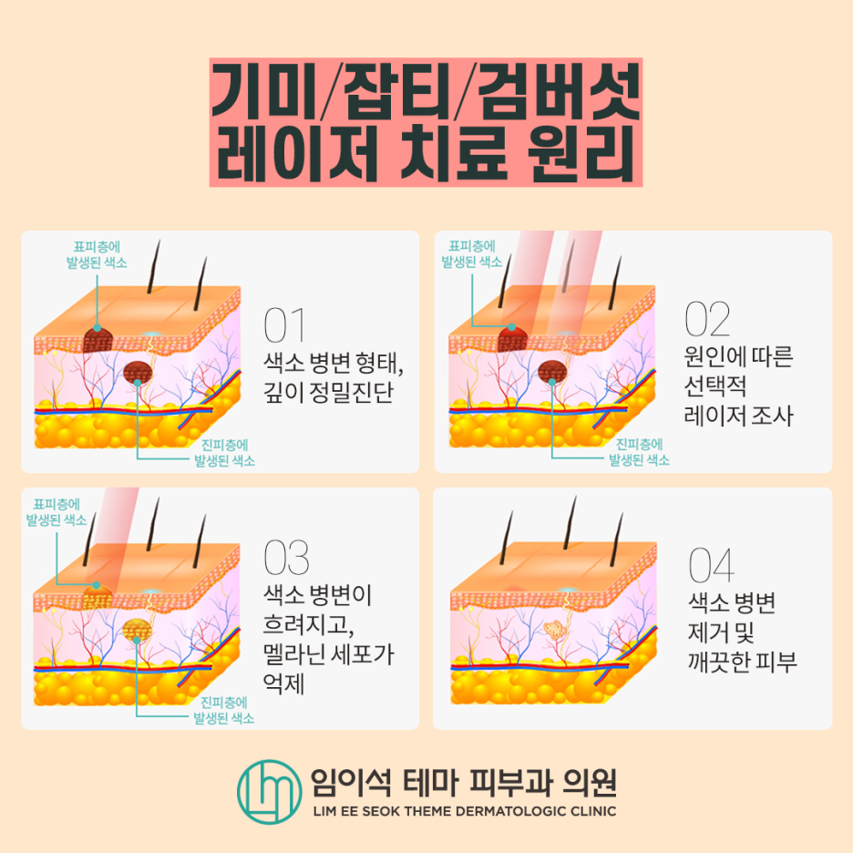 색소질환 치료, 레이저 시술로 개선해보세요! 관련 이미지 5
