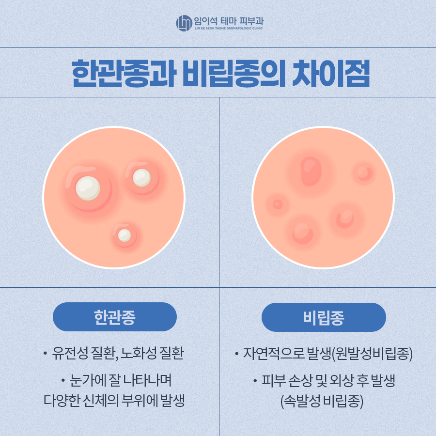 Differences Between Syringoma and Milia and How to Treat Them image 4