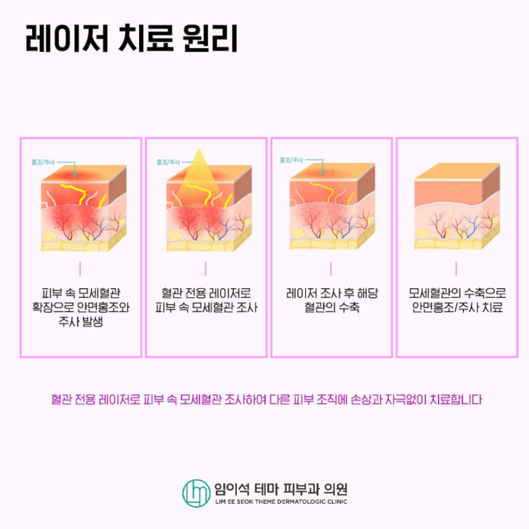 붉은 얼굴, "안면홍조" 증상 완화를 위한 치료법 관련 이미지 7