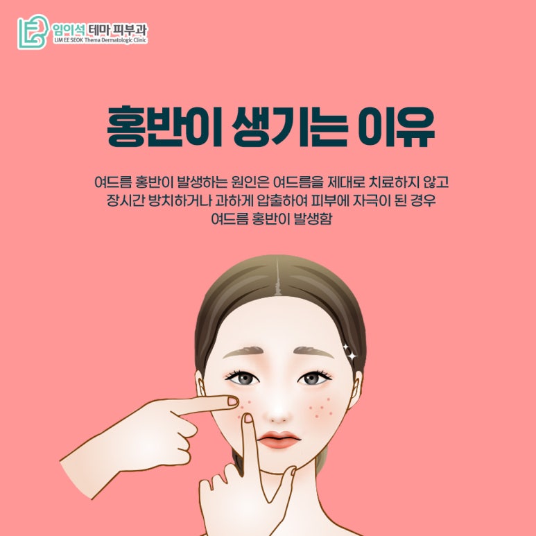 임이석 피부과 여드름 홍반, 예방법과 효과적인 치료 방법은? 관련 이미지 4