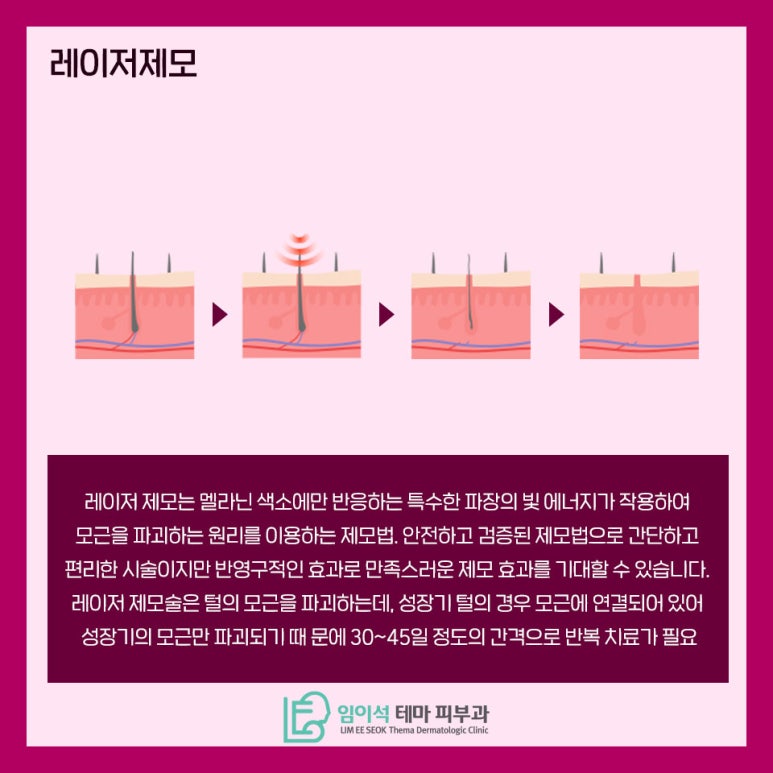 레이저를 이용한 제모부위와 관리법 관련 이미지 3