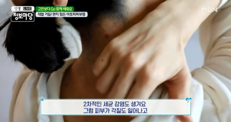 임이석 원장 "주위의 시선이 두려운 피부질환 - 아토피 피부염" MBN 생생정보마당 출연 관련 이미지 11