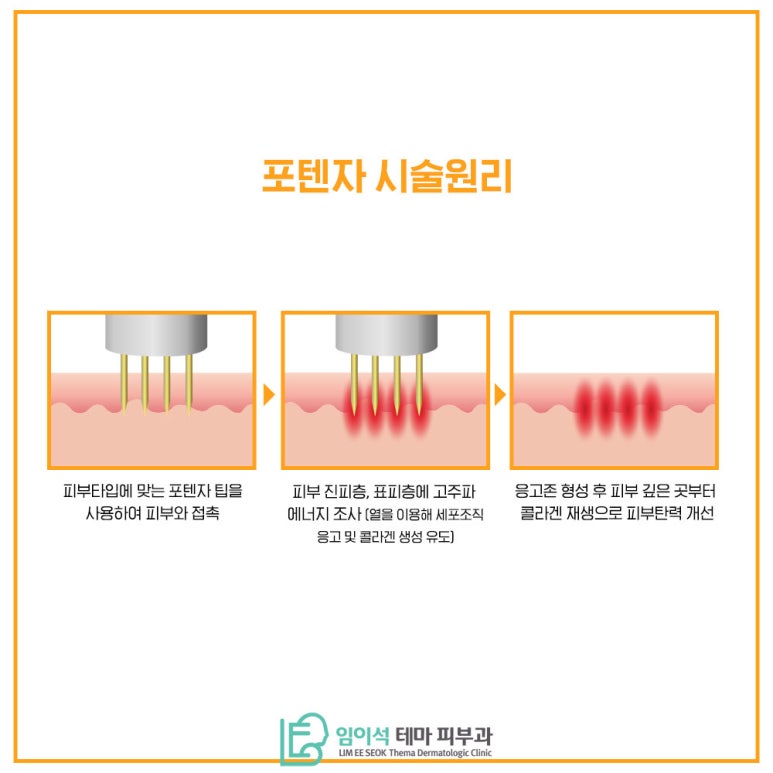 임이석테마피부과에서 알려드리는 고주파 레이저 포텐자 관련 이미지 5