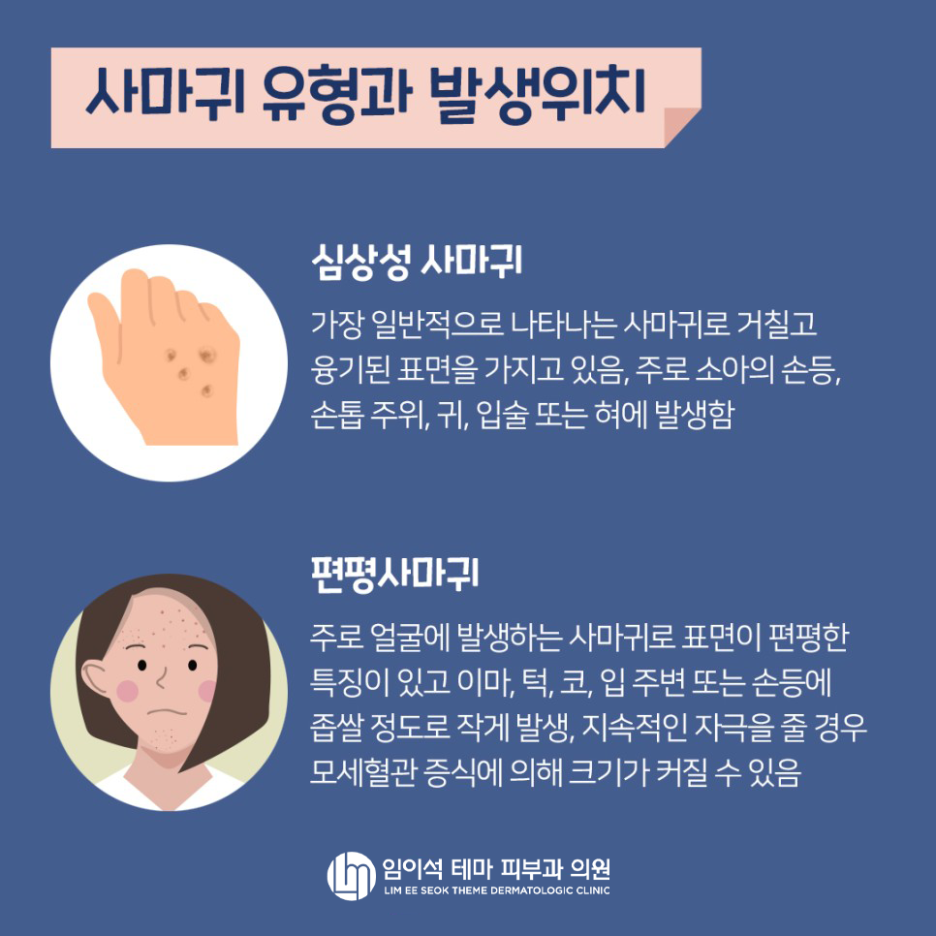 사마귀 원인과 치료법! 임이석 피부과에서 알려드립니다 관련 이미지 4
