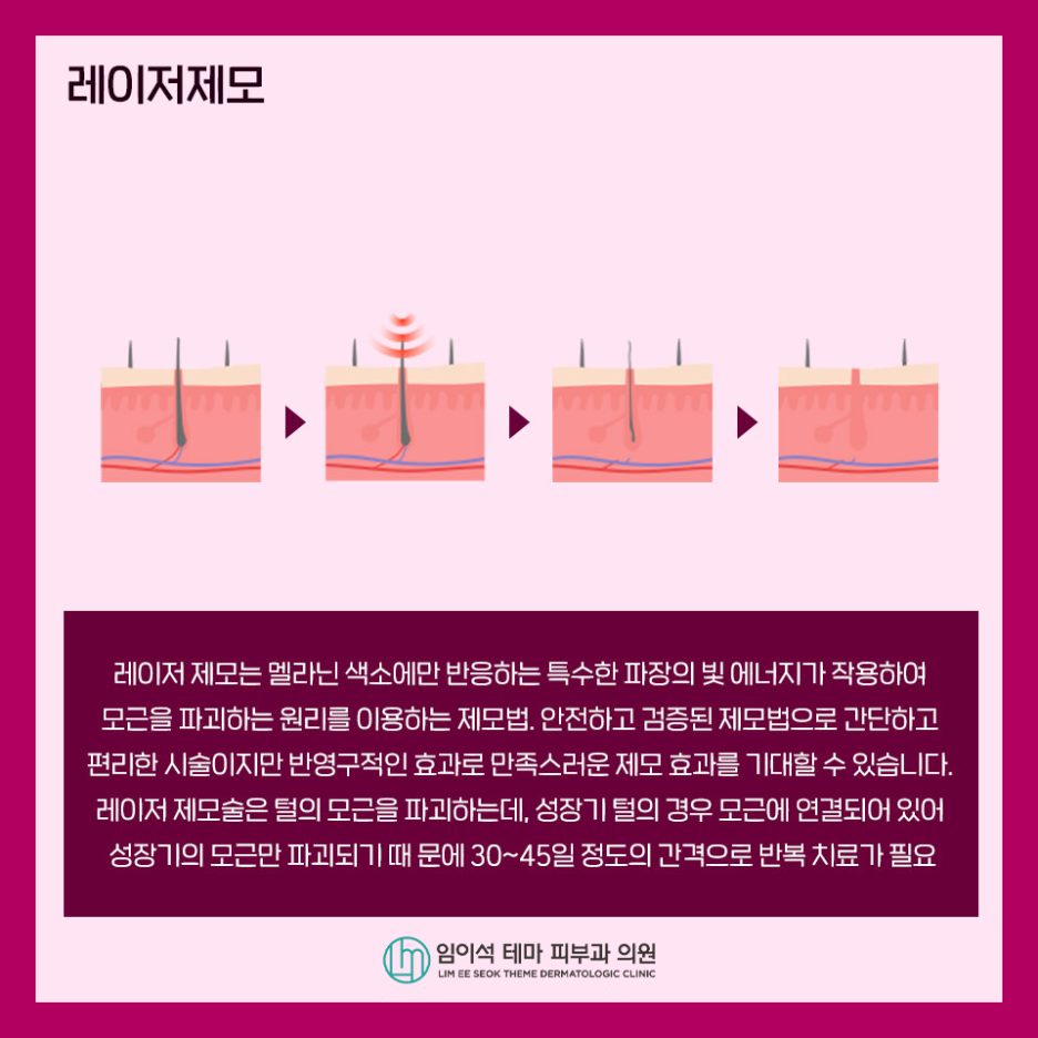 레이저를 이용한 제모부위와 관리법 관련 이미지 3