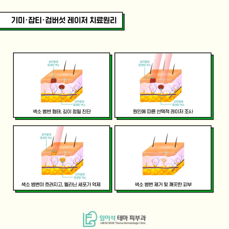 기미 잡티 종류와 원인과 치료방법 관련 이미지 6