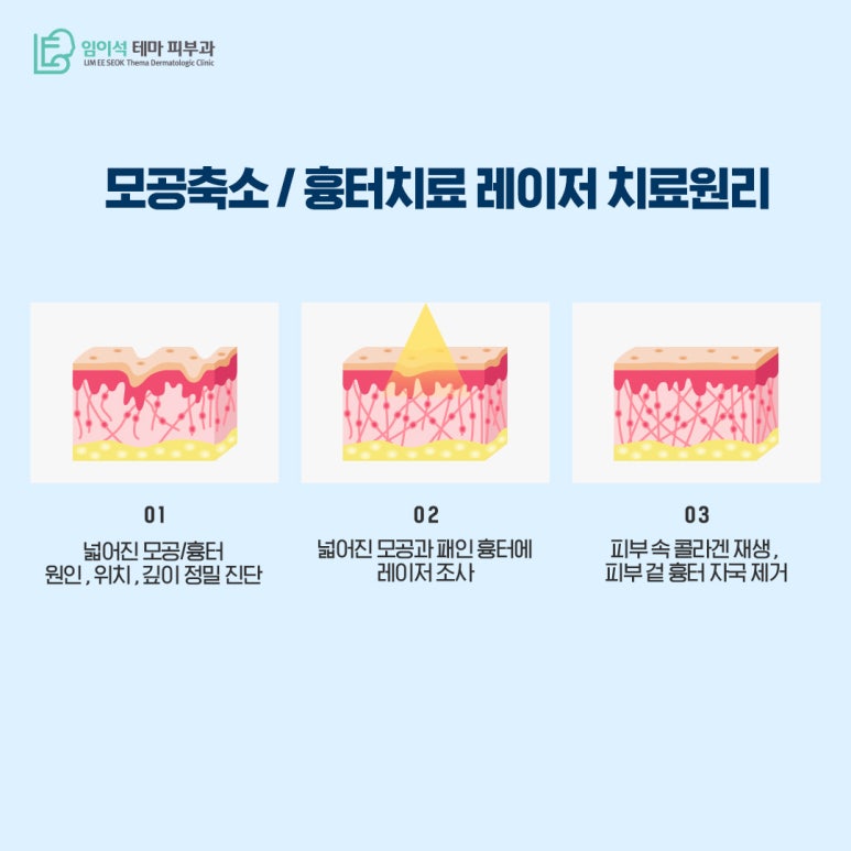 강남 피부과 늘어난 모공 줄이는 방법 관련 이미지 5
