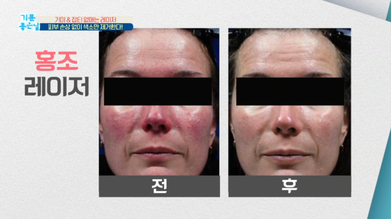 임이석테마피부과 기미를 없애는 법, 기미 레이저 전후 공개! MBC 기분좋은날 출연 관련 이미지 19