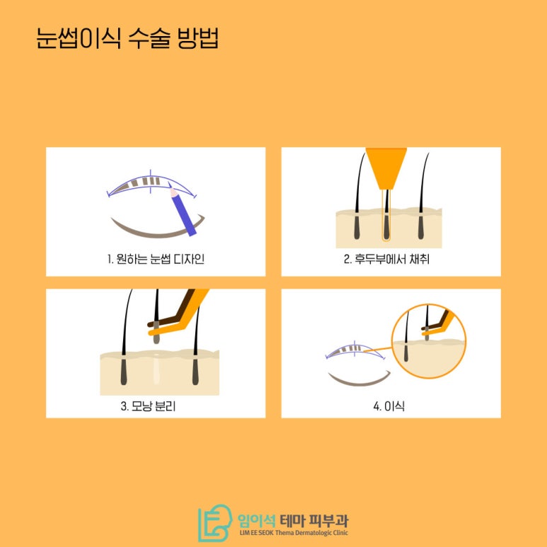 Eyebrow Transplant Methods That Suit Your Face, as Recommended by Imi-seok Theme Dermatology image 6