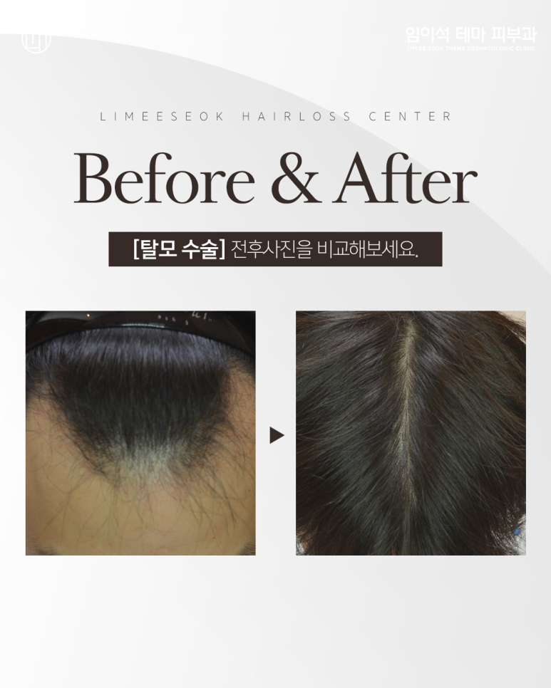 Gapsa Station Dermatology: Do You Really Need Hair Transplant Surgery for Hair Loss? image 5