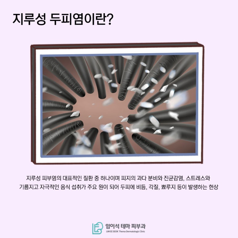 [임이석테마피부과] 지루성 두피염 방치하면 지루성 탈모된다!? 관련 이미지 3