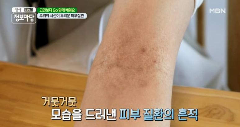 임이석 원장 "주위의 시선이 두려운 피부질환 - 아토피 피부염" MBN 생생정보마당 출연 관련 이미지 2