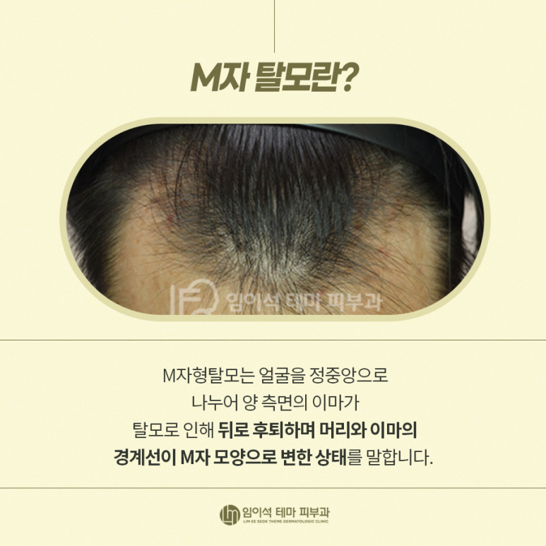 Alopecia Areata, M-Shaped Hair Loss Symptoms, and Self-Diagnosis Methods for Hair Loss image 5