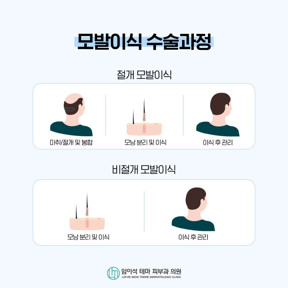 모발이식, 나에게 맞는 수술 찾는 방법 관련 이미지 7