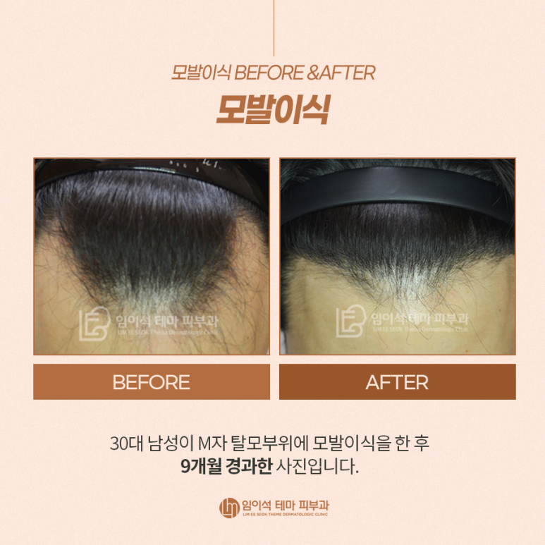 모발이식 Before&After와 이식 시 주의사항 관련 이미지 4