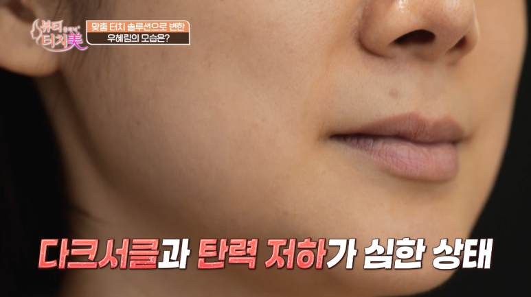 우혜림 피부 고민, 출산 후 달라진 피부 탄력과 볼꺼짐|임이석테마피부과 임이석 대표원장 (채널A 뷰티클리닉 터치미 8화) 관련 이미지 1