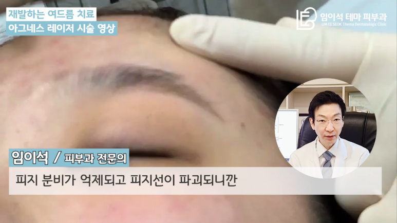 [Imi-seok Thema Dermatology YouTube Dr. Imi-seok Channel] Laser Treatment for Recurrent Acne image 5